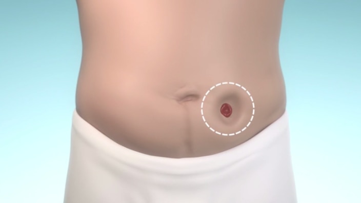 Find your right stoma bag