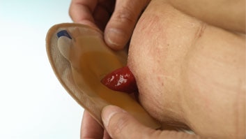 How to put on your ostomy bag