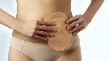Why do I need to wear an ostomy bag? 