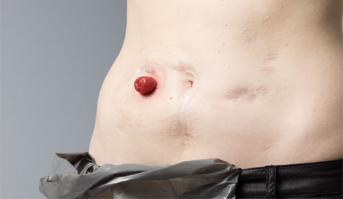 Ileostomy leakage troubleshooter
