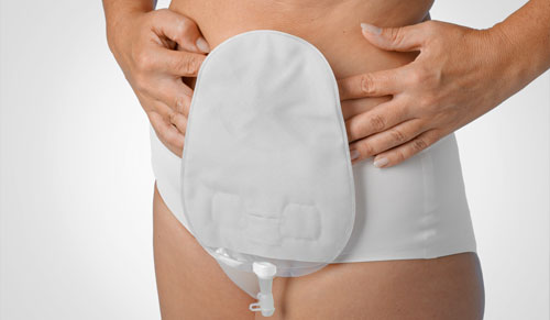 Urostomy leakage troubleshooter
