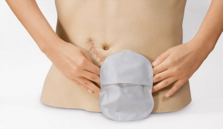 How to prevent the stoma from smelling